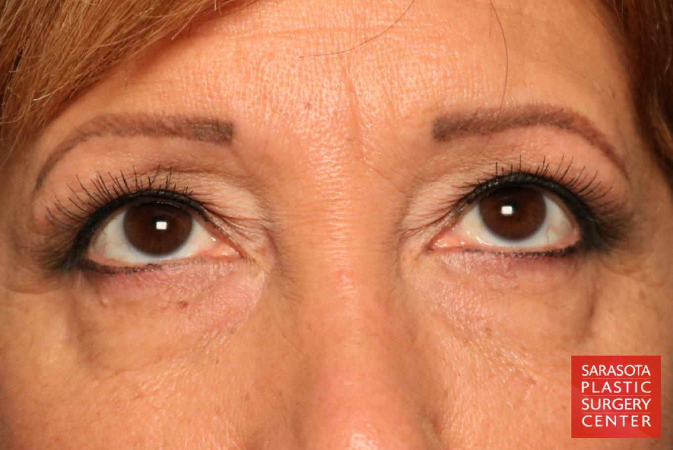Eyelid Lift: Patient 9 - Before 3