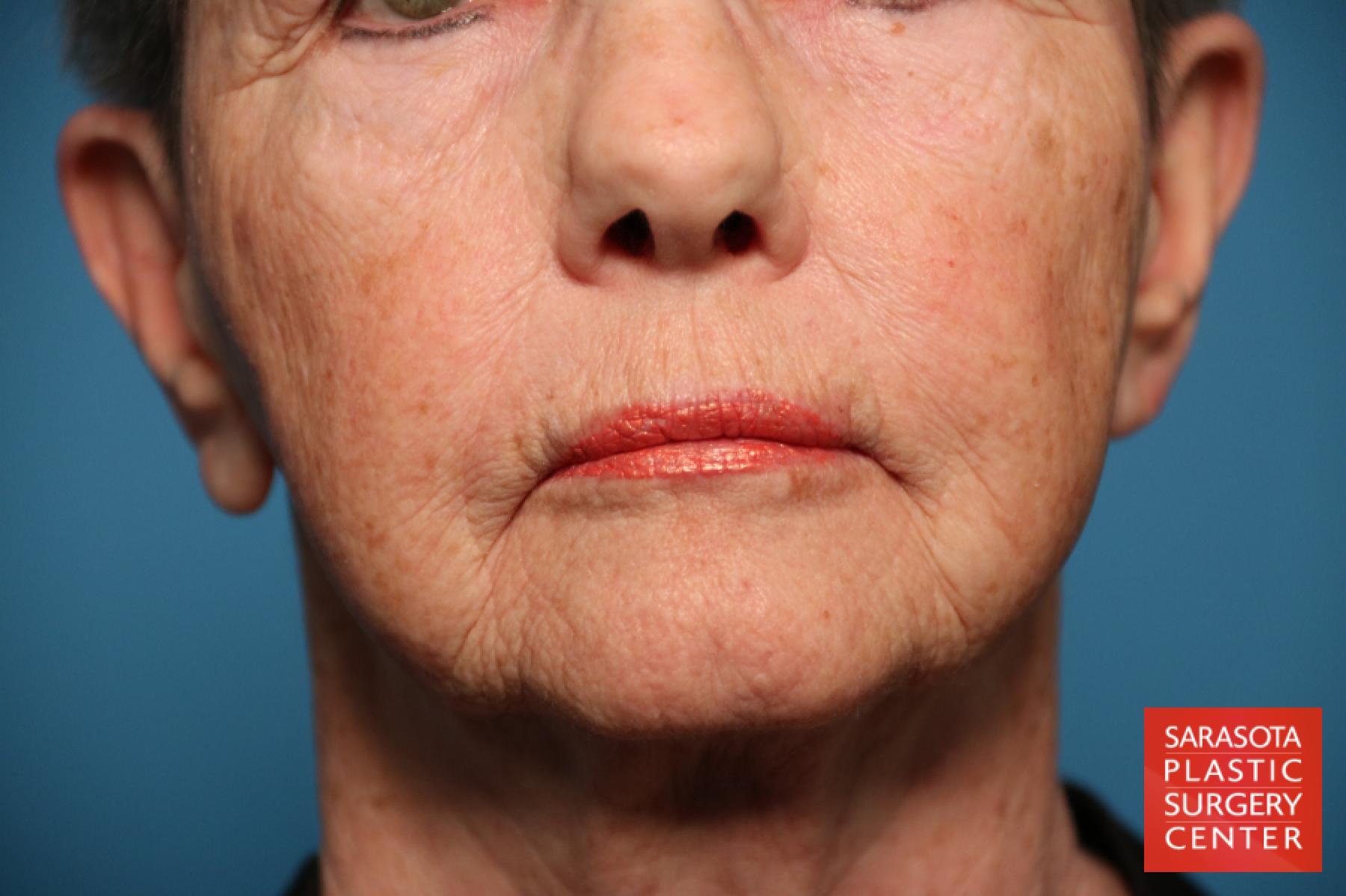 Laser Skin Resurfacing - Face: Patient 14 - Before 1