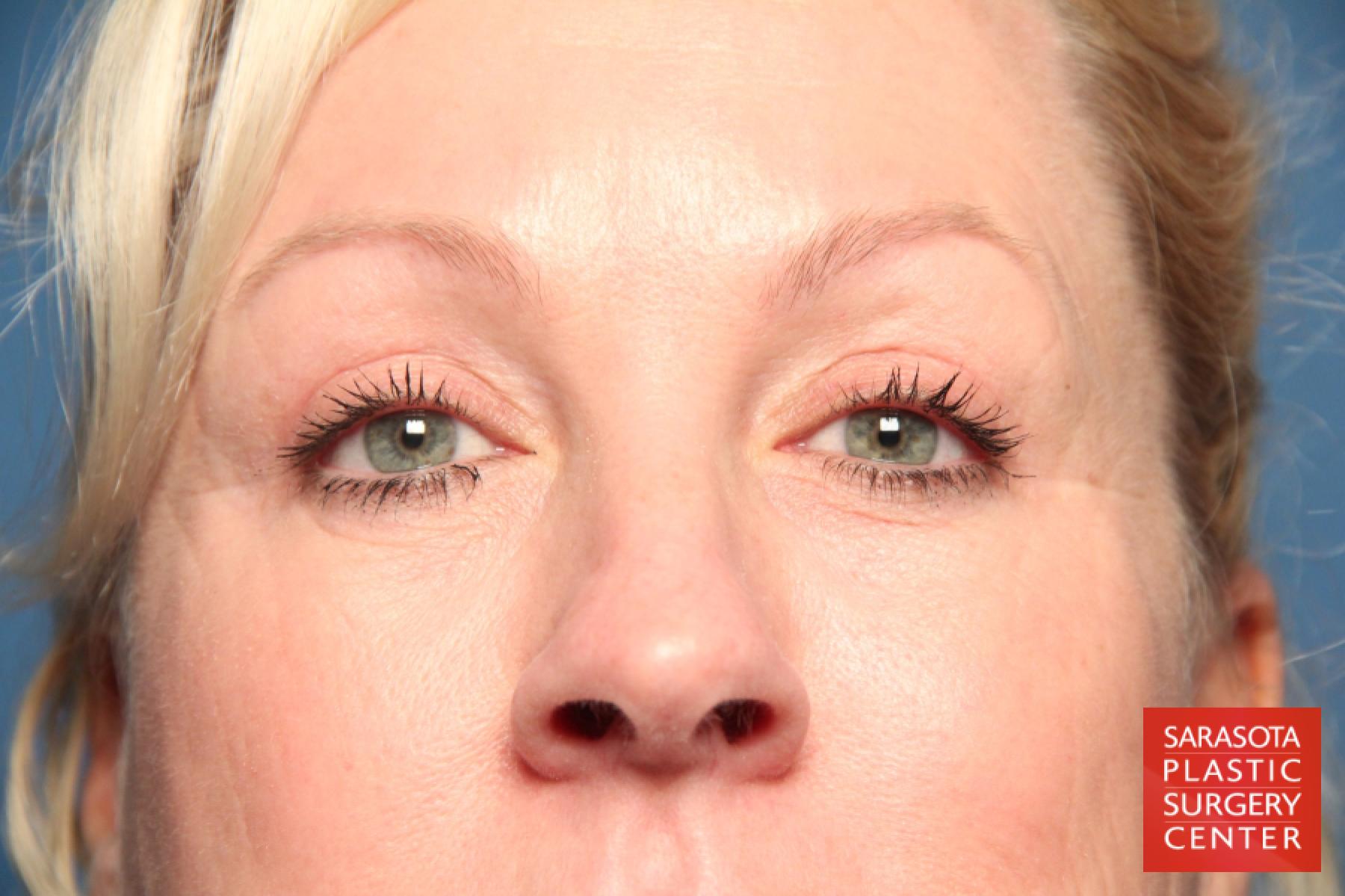 Eyelid Lift: Patient 4 - After 1