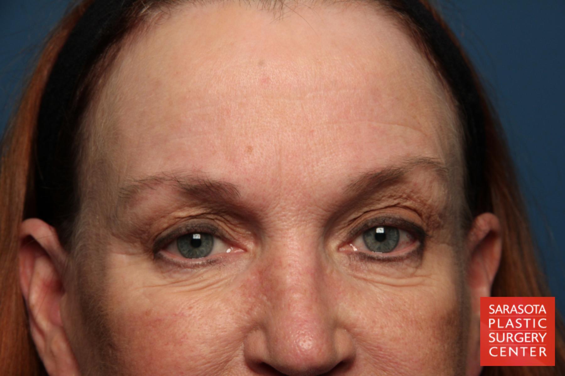 Eyelid Lift: Patient 26 - Before 1