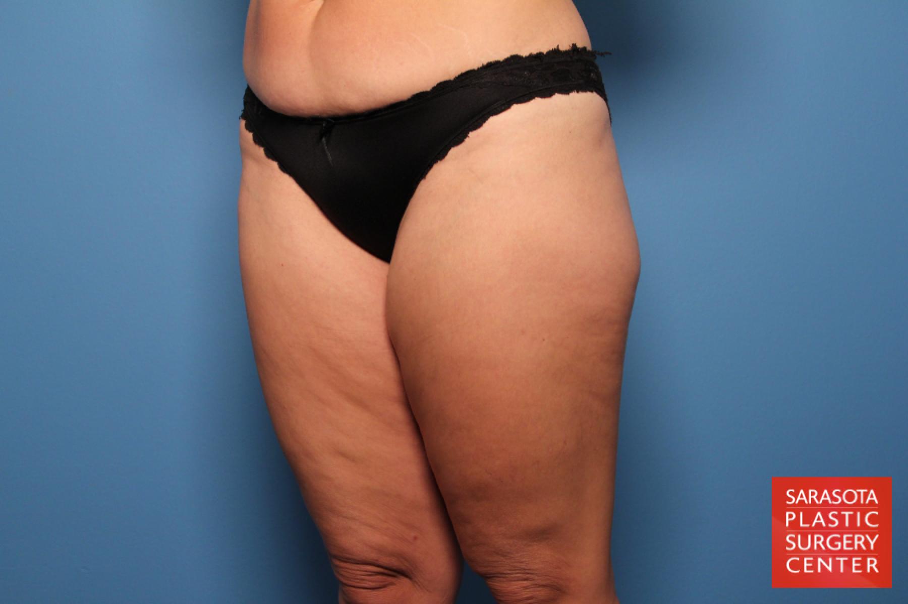 Liposuction: Patient 6 - Before 2