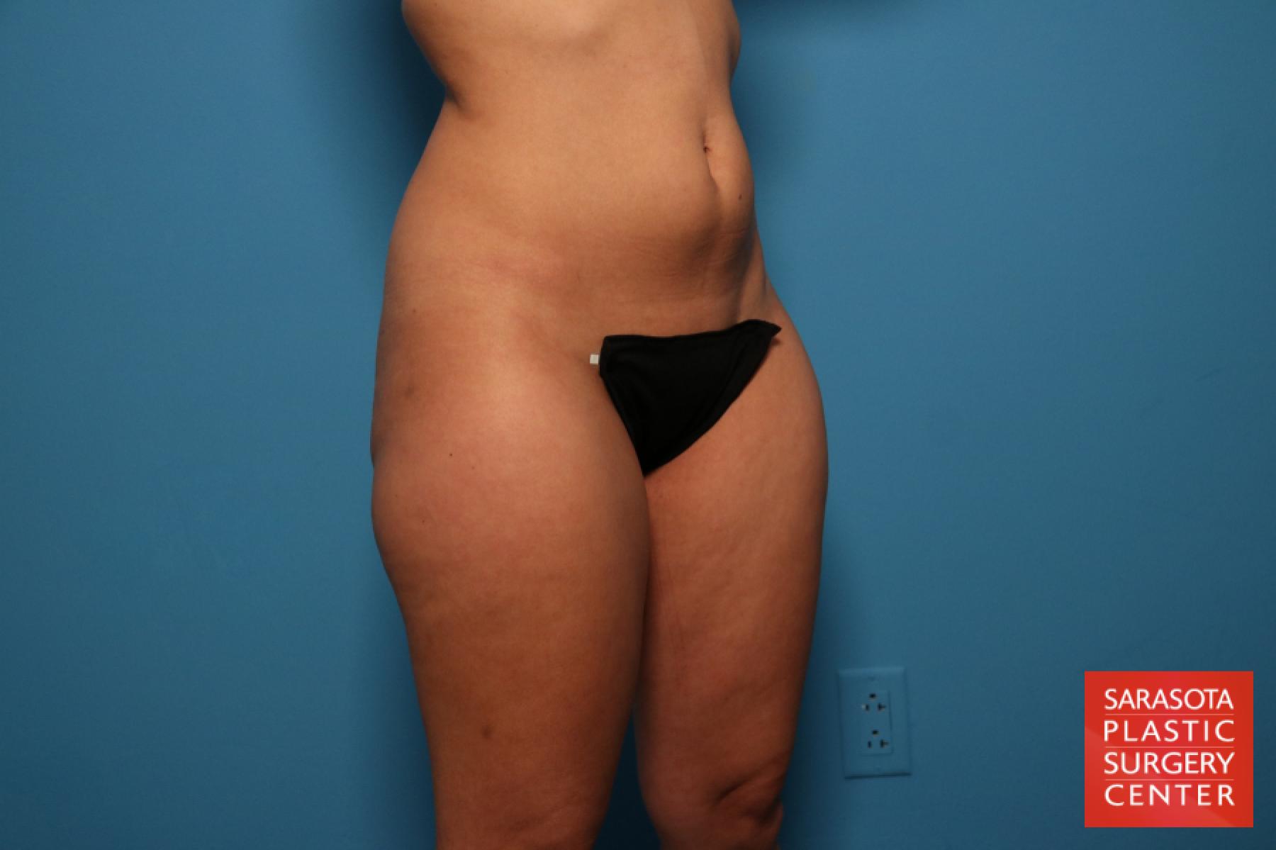 Liposuction: Patient 13 - Before 2