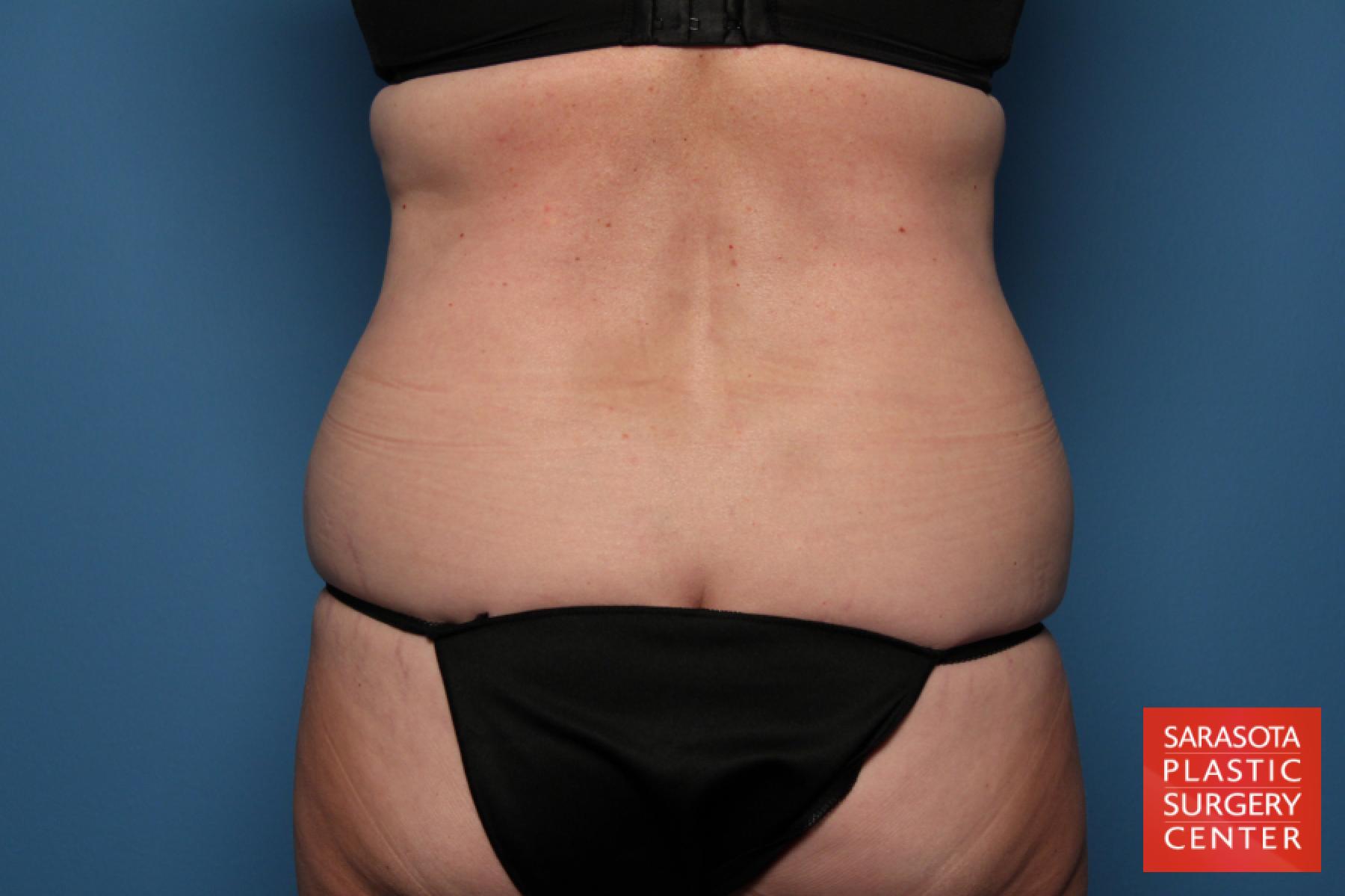 Tummy Tuck: Patient 18 - Before and After 5