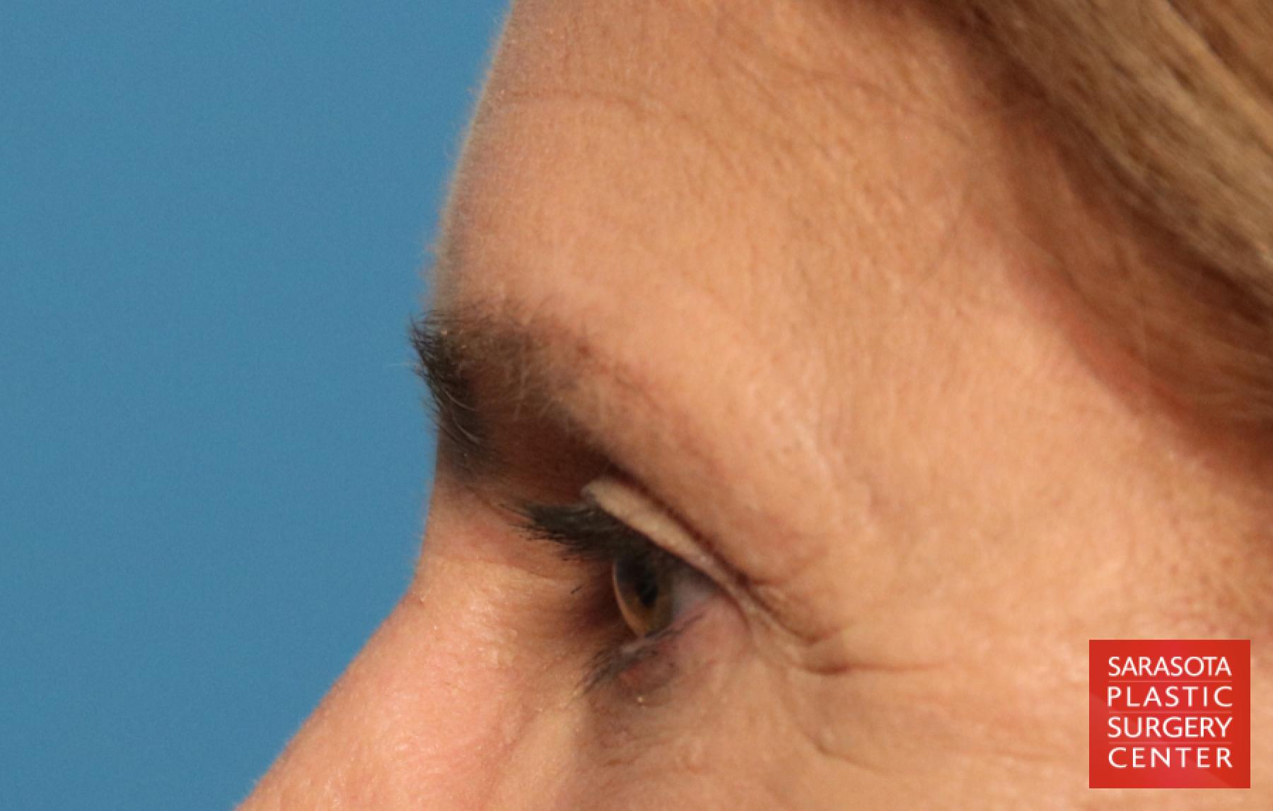 Eyelid Lift: Patient 28 - After 3