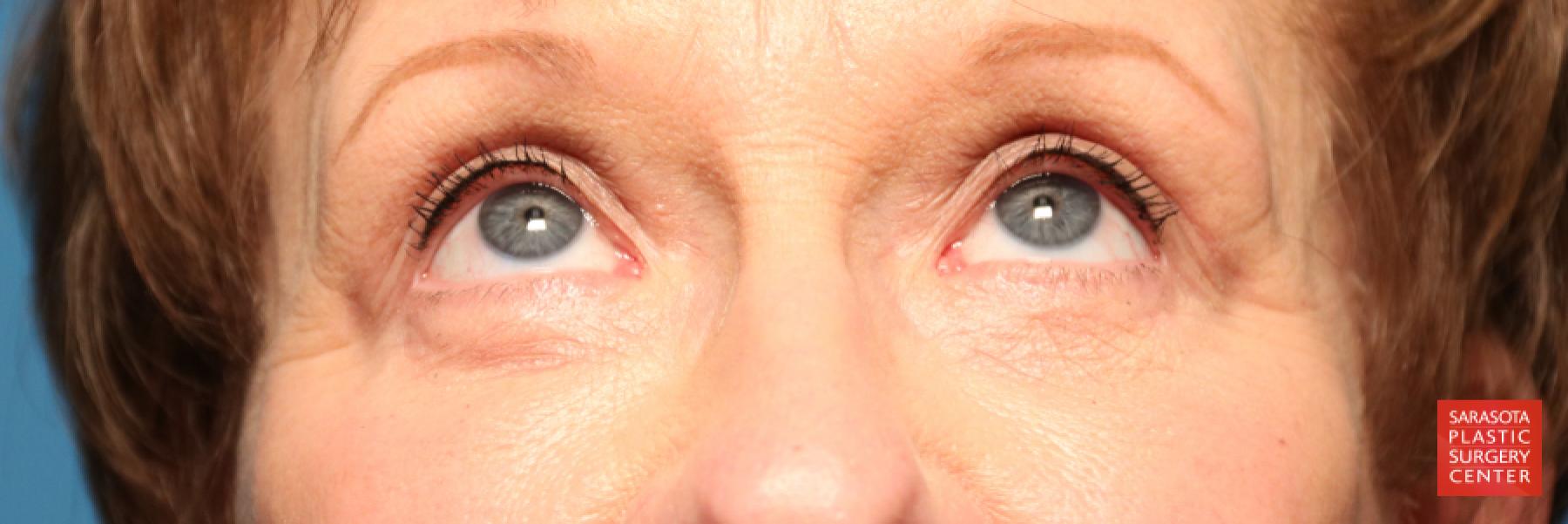 Eyelid Lift: Patient 20 - After 2
