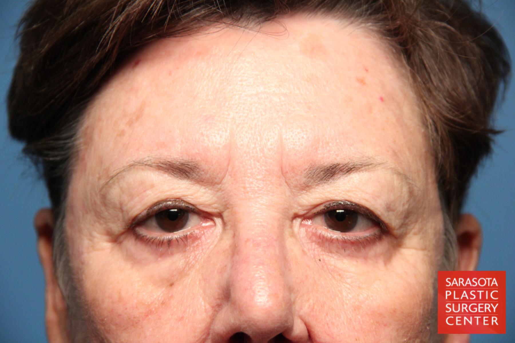 Eyelid Lift: Patient 17 - Before 1