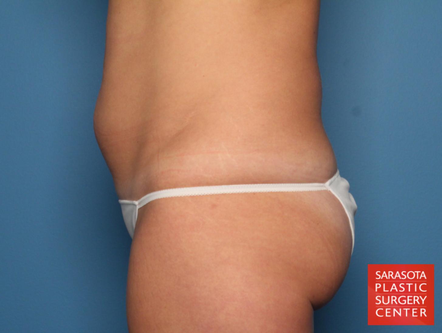 Tummy Tuck: Patient 20 - Before and After 3