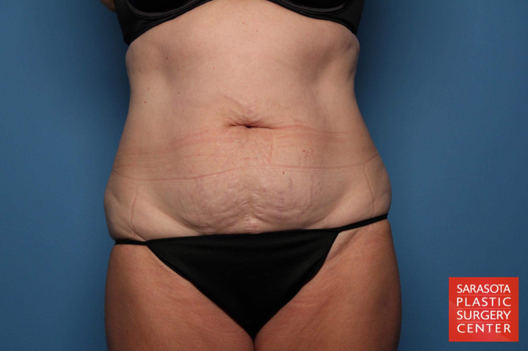 Tummy Tuck: Patient 18 - Before 1