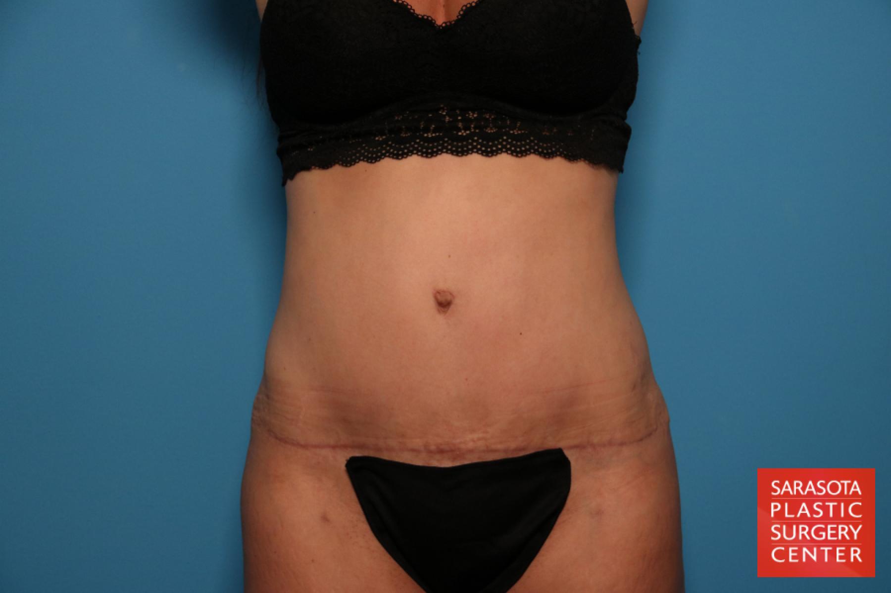 Tummy Tuck: Patient 14 - After 1