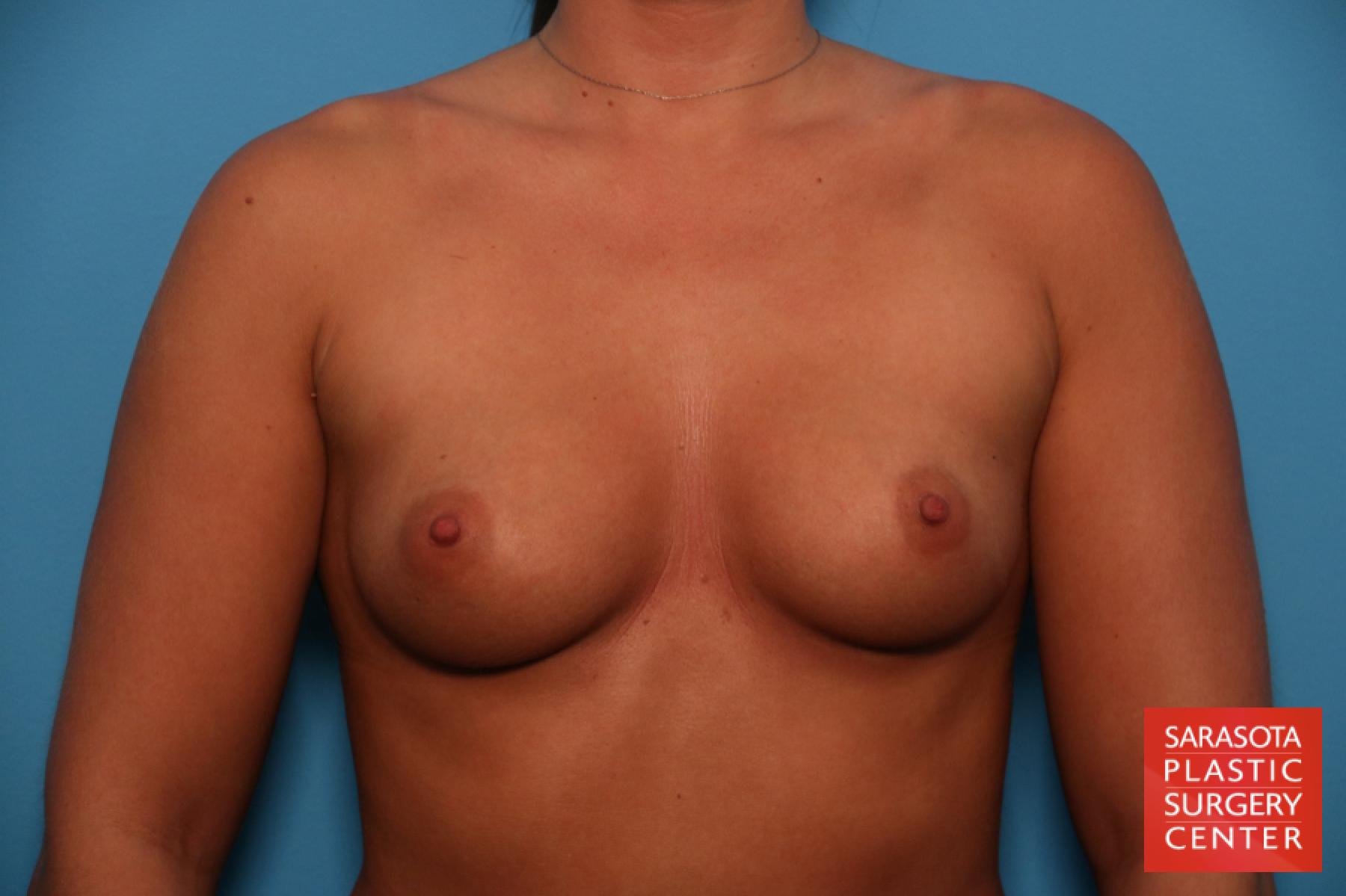 Breast Augmentation: Patient 55 - Before 1