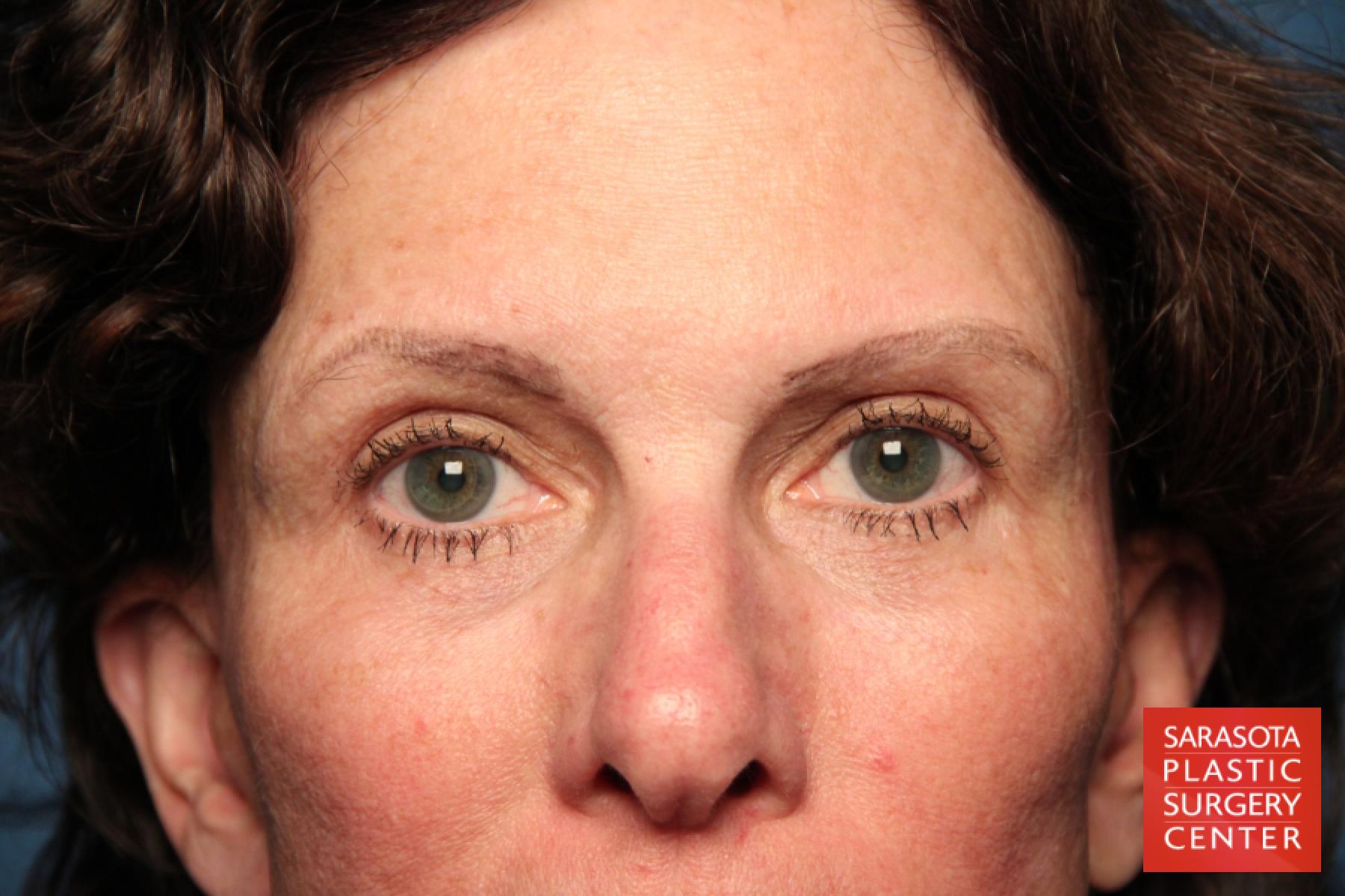 Eyelid Lift: Patient 8 - After  