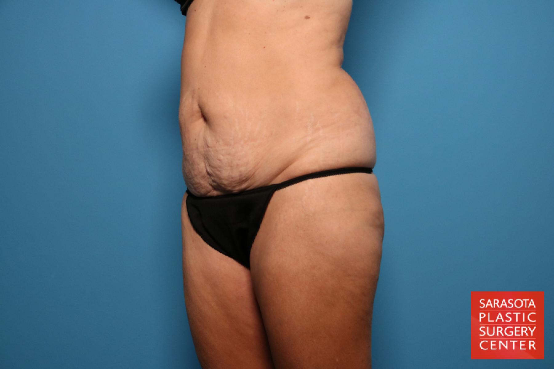 Tummy Tuck: Patient 13 - Before 2