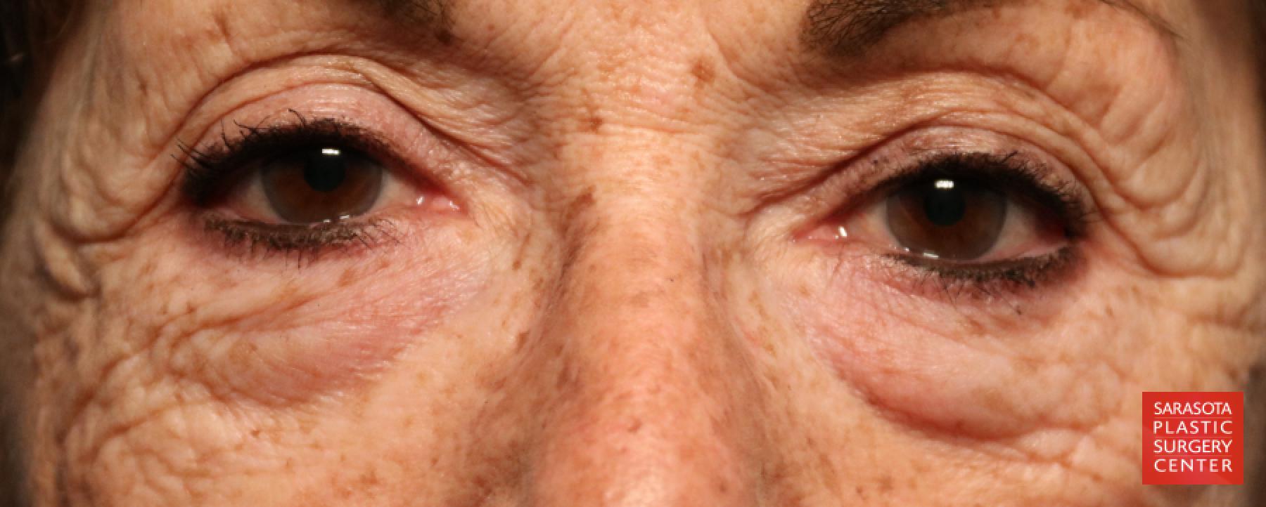 Eyelid Lift: Patient 6 - Before 