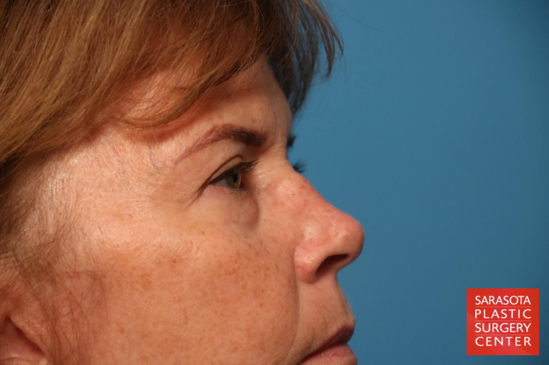 Eyelid Lift: Patient 37 - Before and After 4