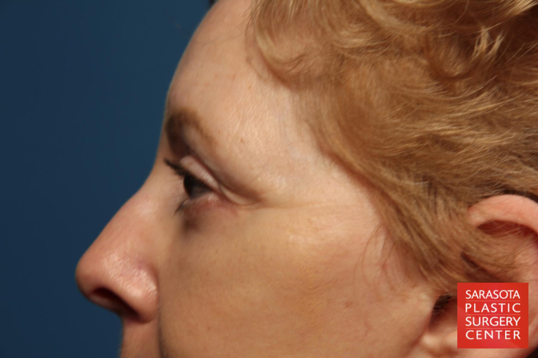 Eyelid Lift: Patient 41 - After 4