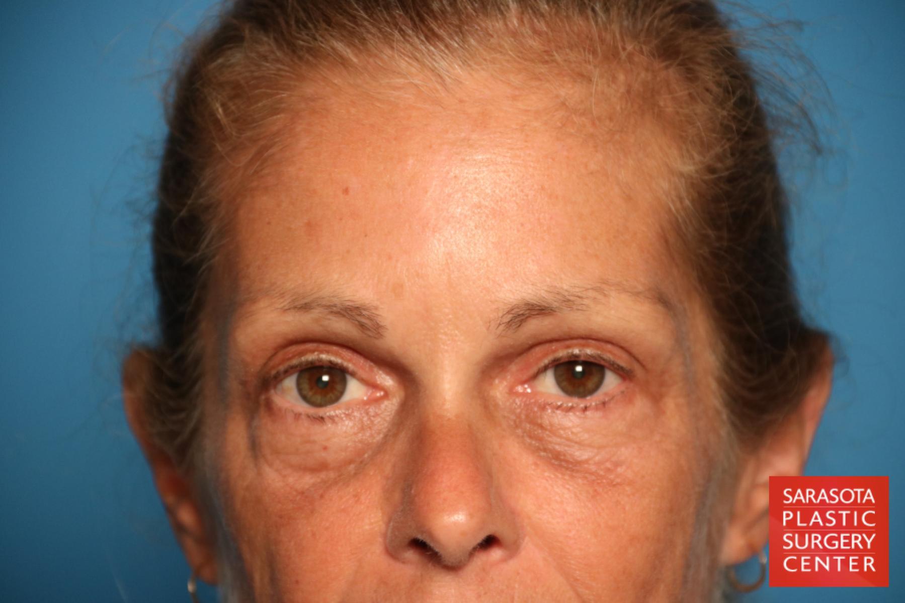 Brow Lift: Patient 2 - After 1