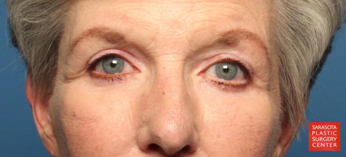 Eyelid Lift: Patient 34 - After 1