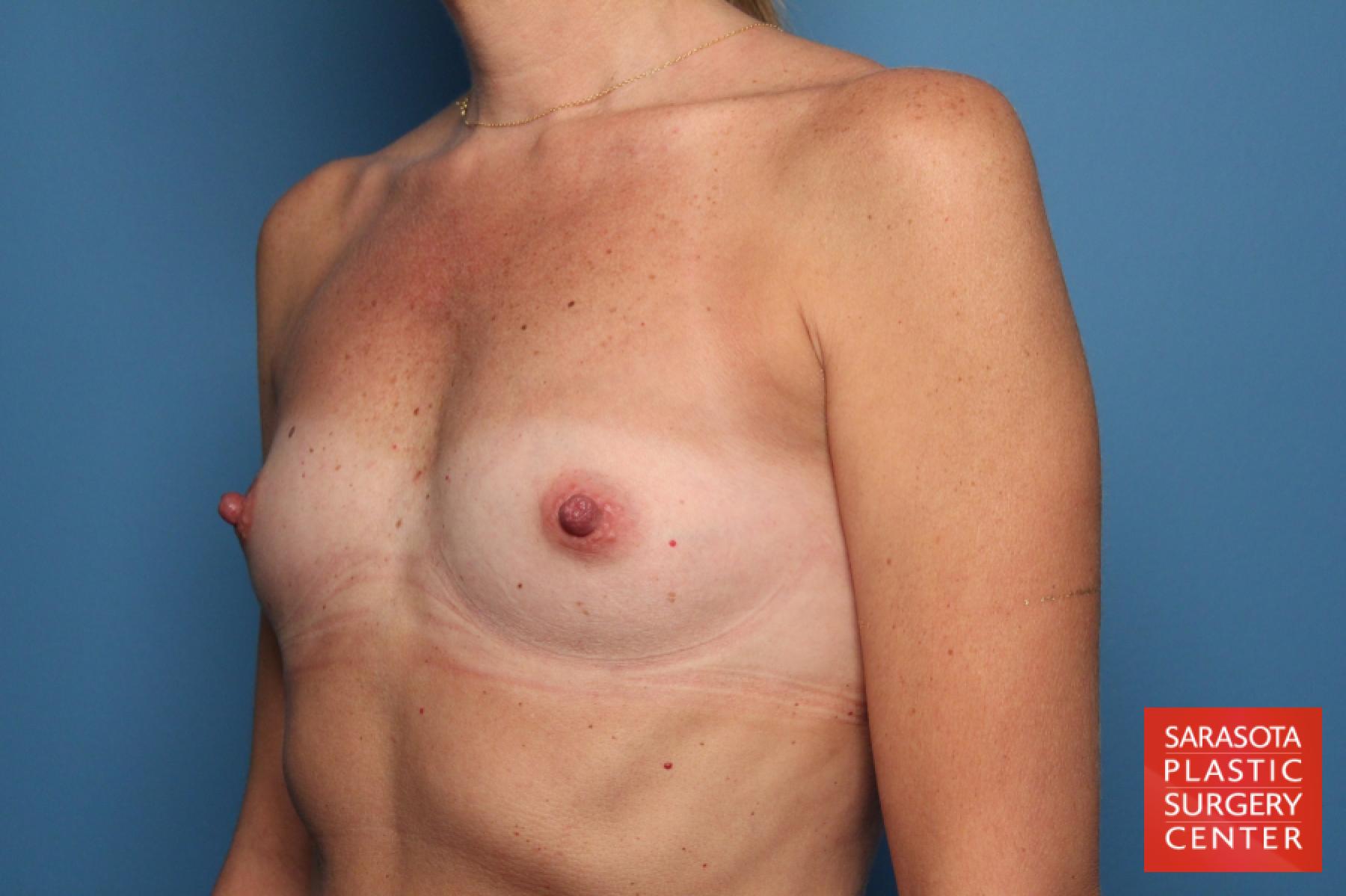 Breast Augmentation: Patient 19 - Before 2