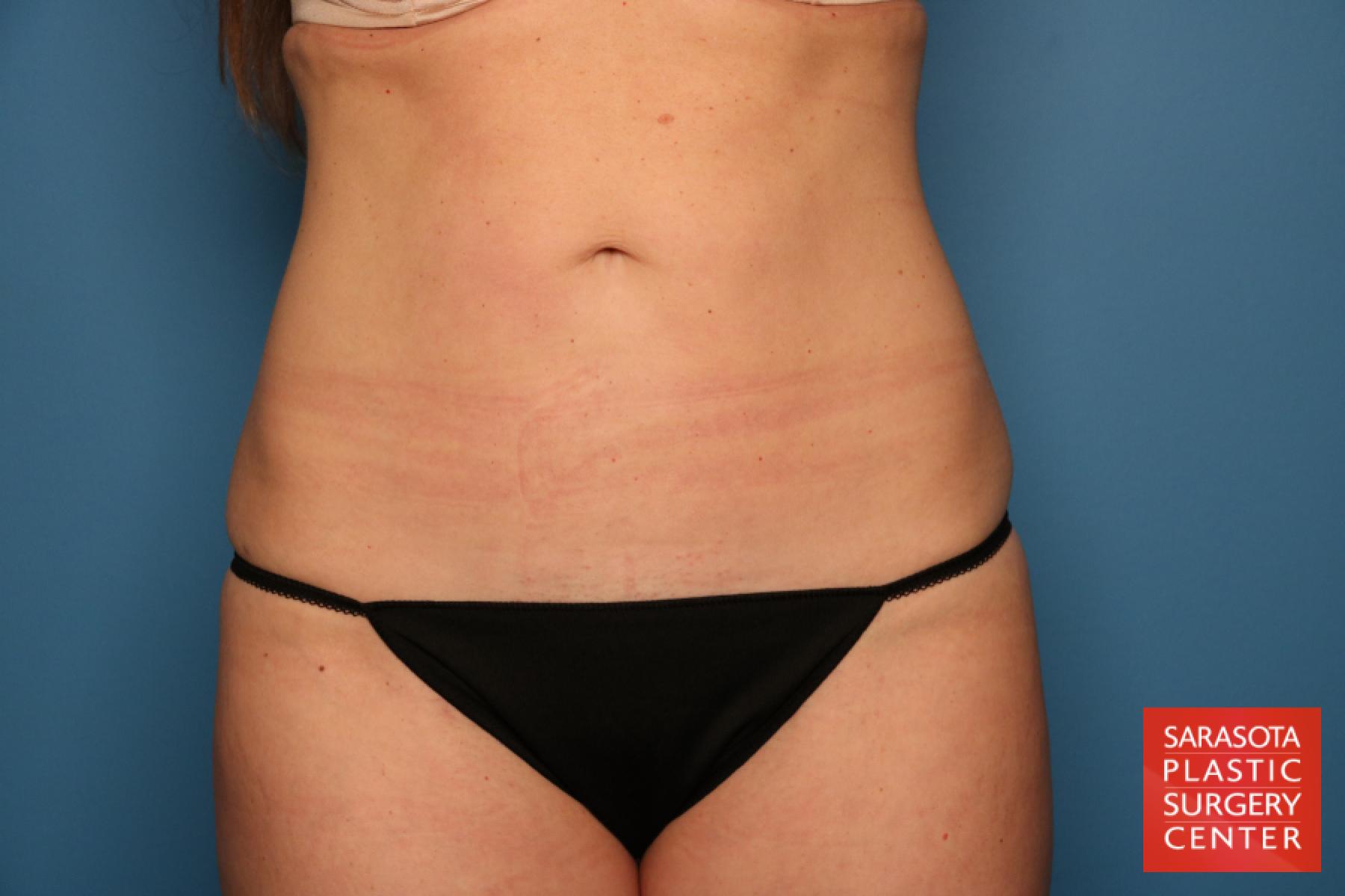 Liposuction: Patient 4 - After 1