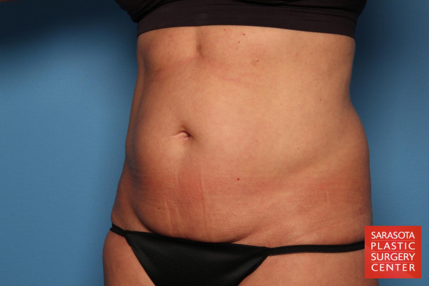 Tummy Tuck: Patient 25 - Before 2