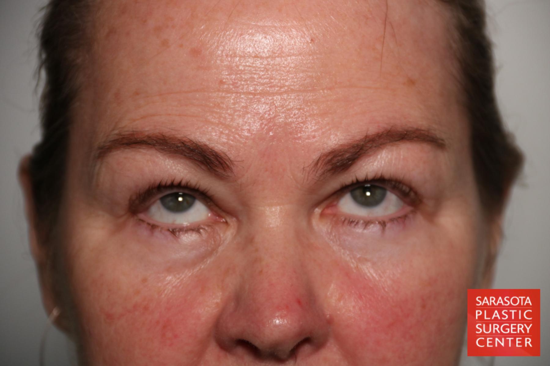 Eyelid Lift: Patient 44 - Before 3