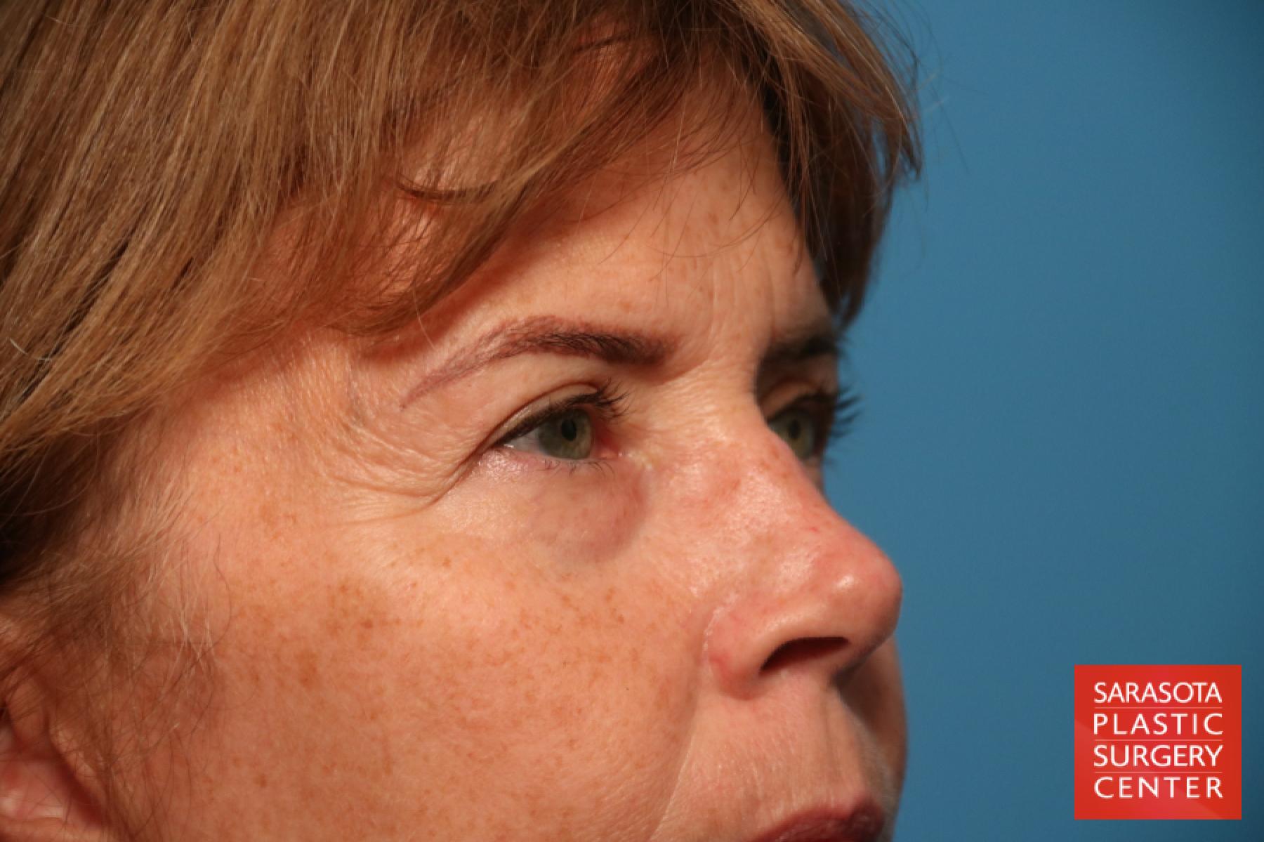 Eyelid Lift: Patient 37 - Before 3