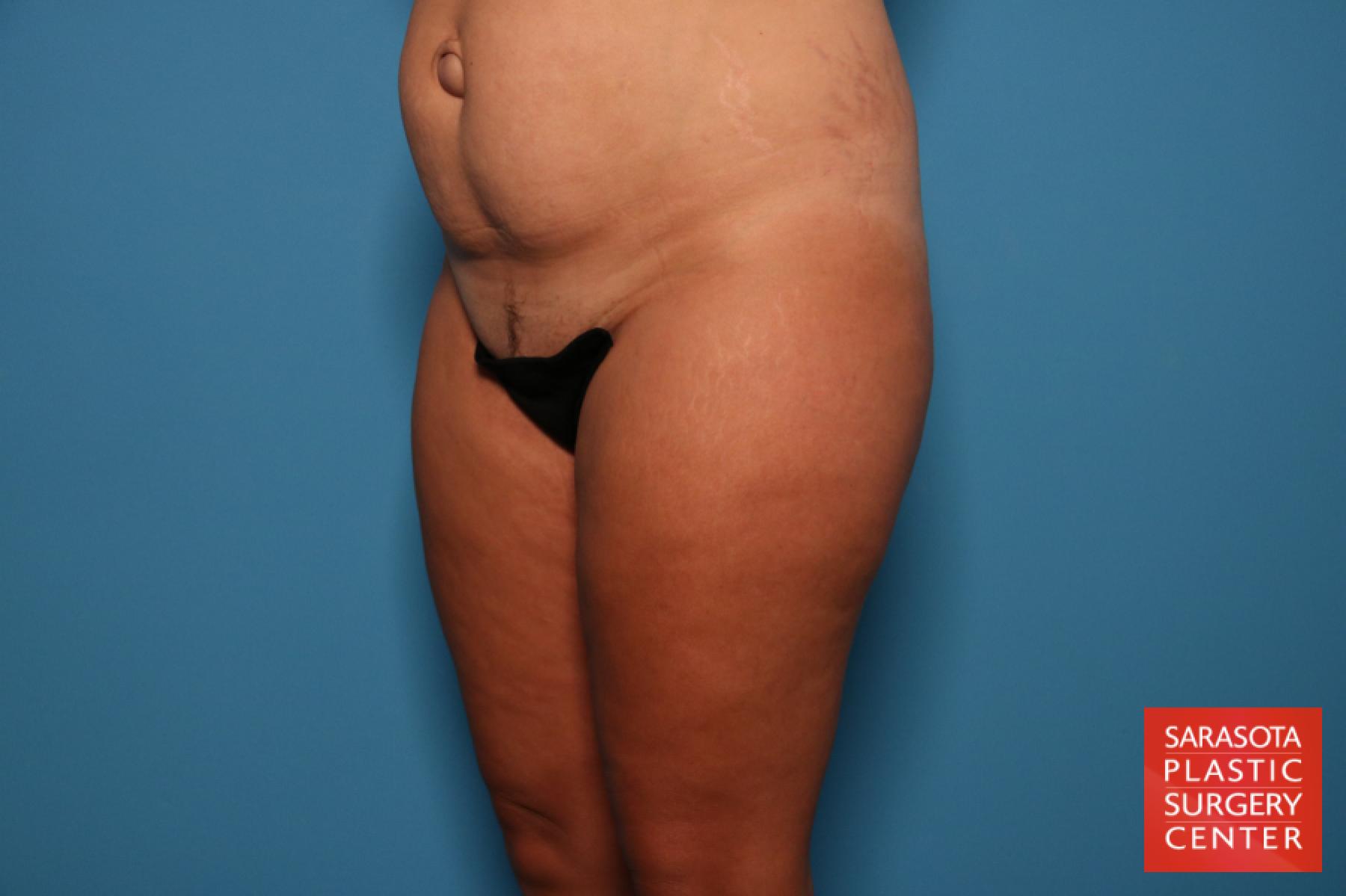 Liposuction: Patient 7 - Before 3