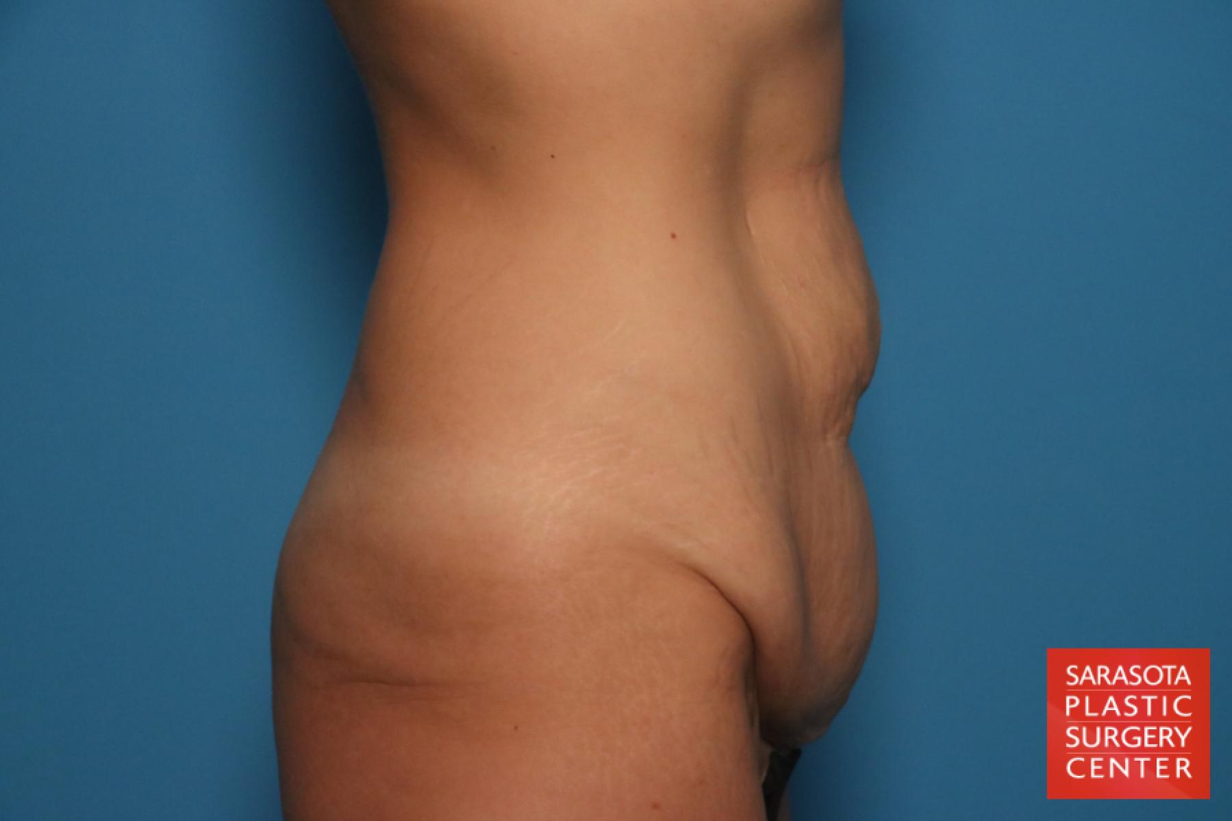 Tummy Tuck: Patient 26 - Before and After 3