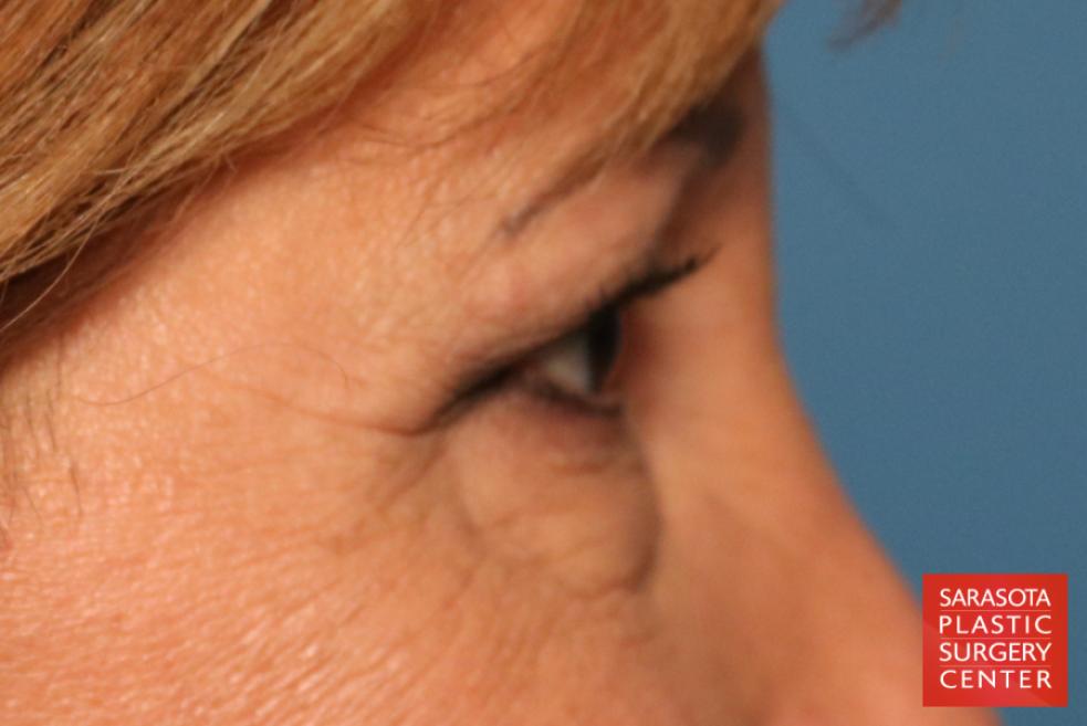 Eyelid Lift: Patient 9 - Before and After 7