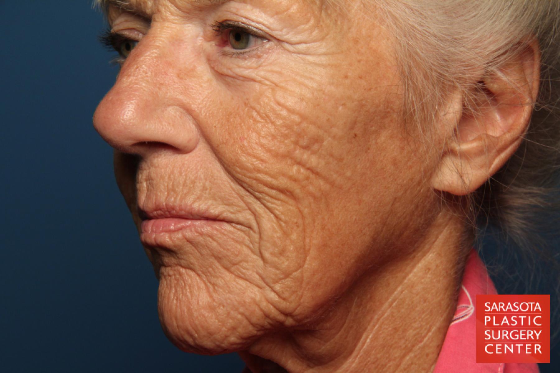 Laser Skin Resurfacing - Face: Patient 8 - Before 2