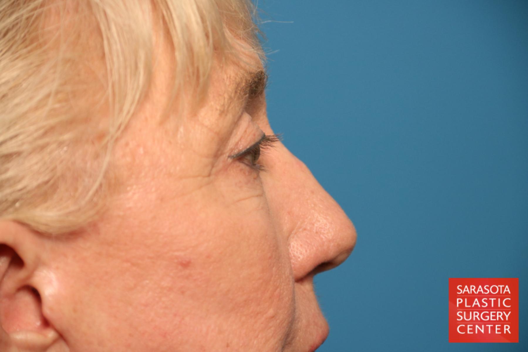 Eyelid Lift: Patient 45 - After 3