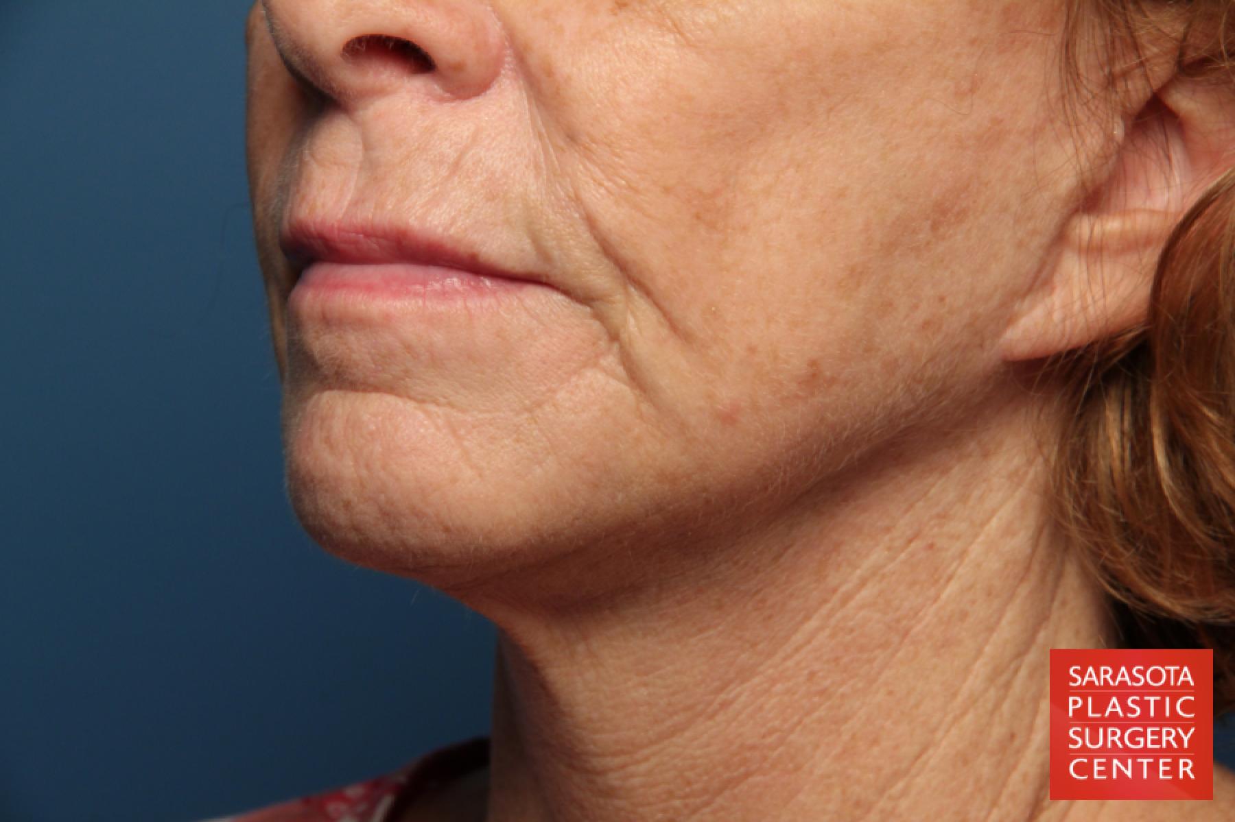 Laser Skin Resurfacing - Face: Patient 12 - Before 2