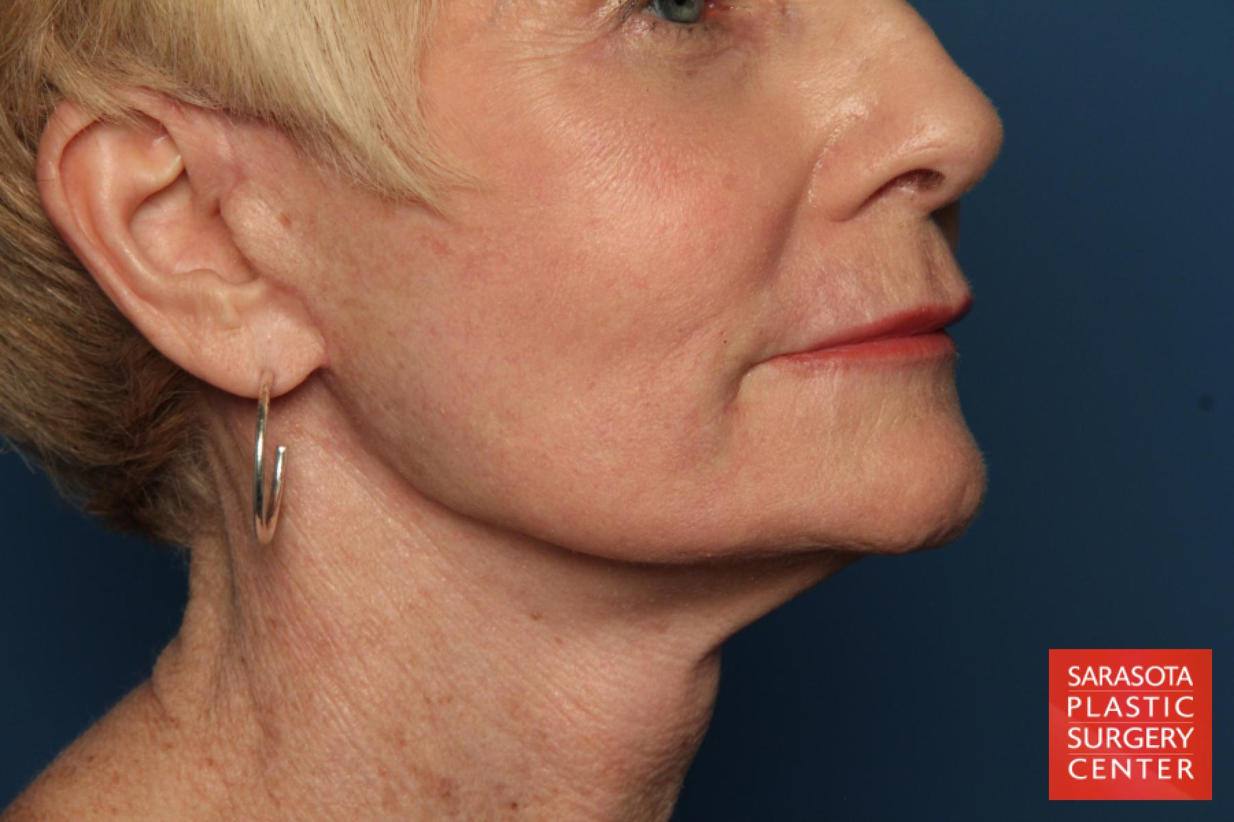Laser Skin Resurfacing - Face: Patient 15 - After 4
