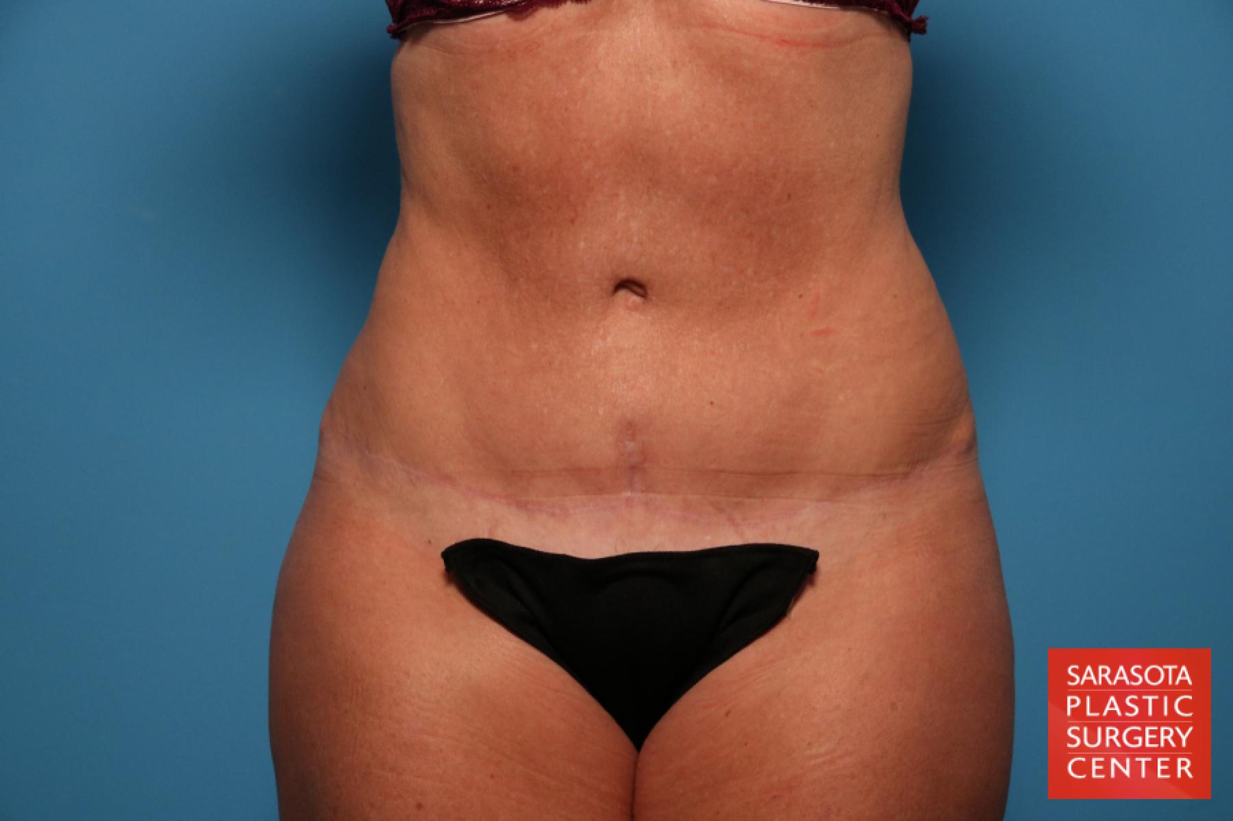 Tummy Tuck: Patient 1 - After 1