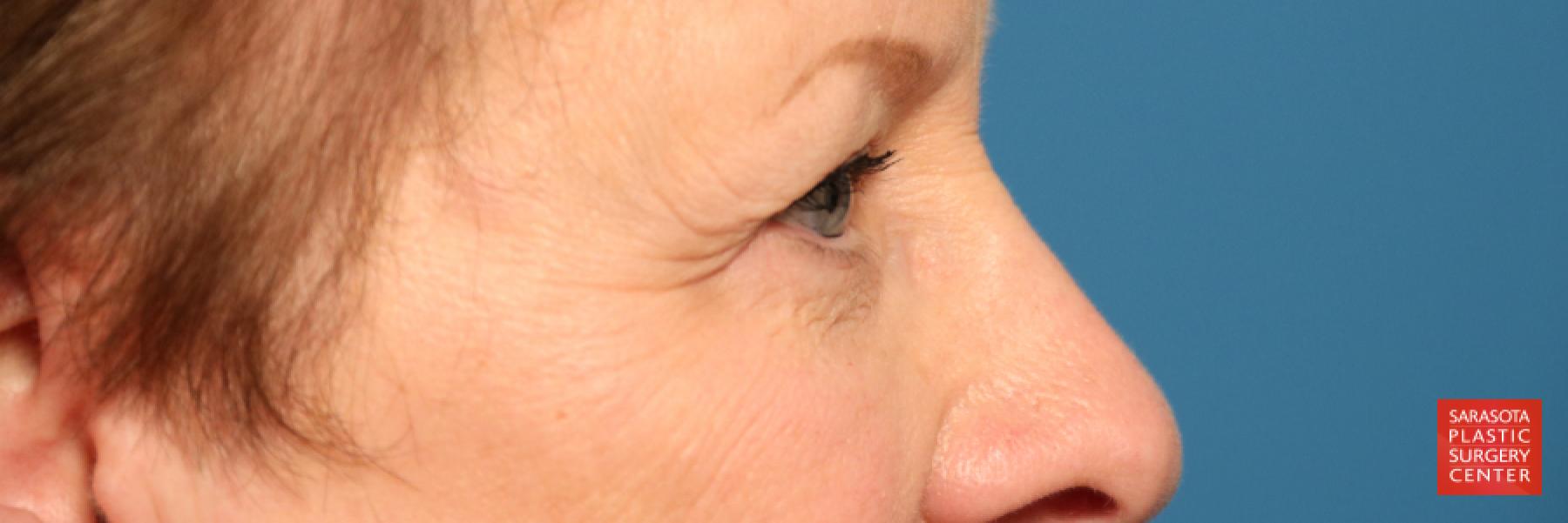 Eyelid Lift: Patient 20 - Before and After 5
