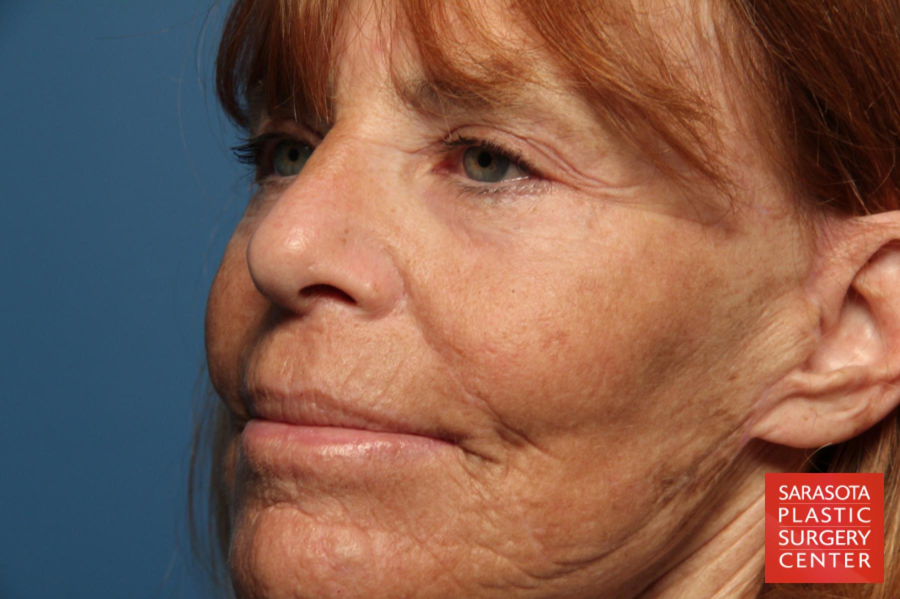 Laser Skin Resurfacing - Face: Patient 16 - After 2