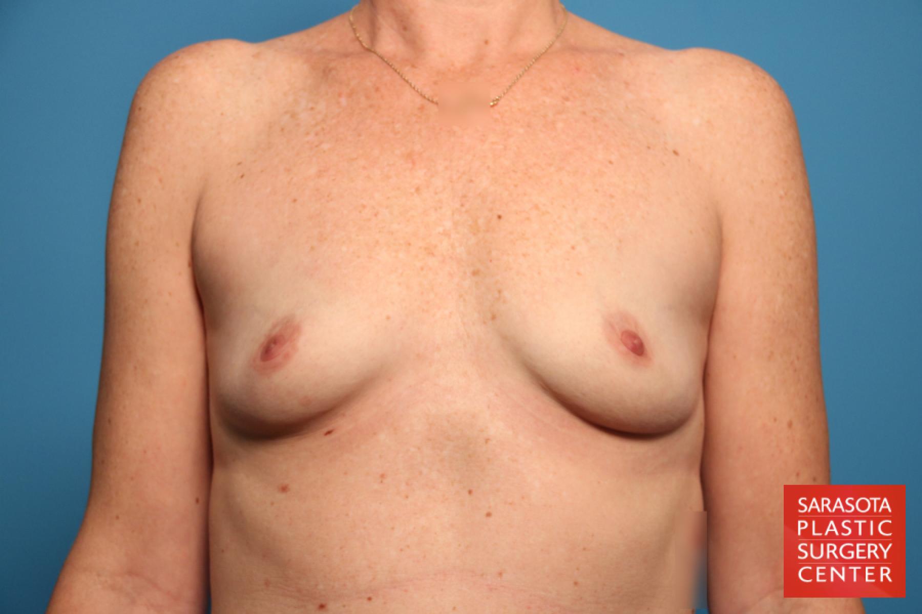 Breast Augmentation: Patient 46 - Before 1
