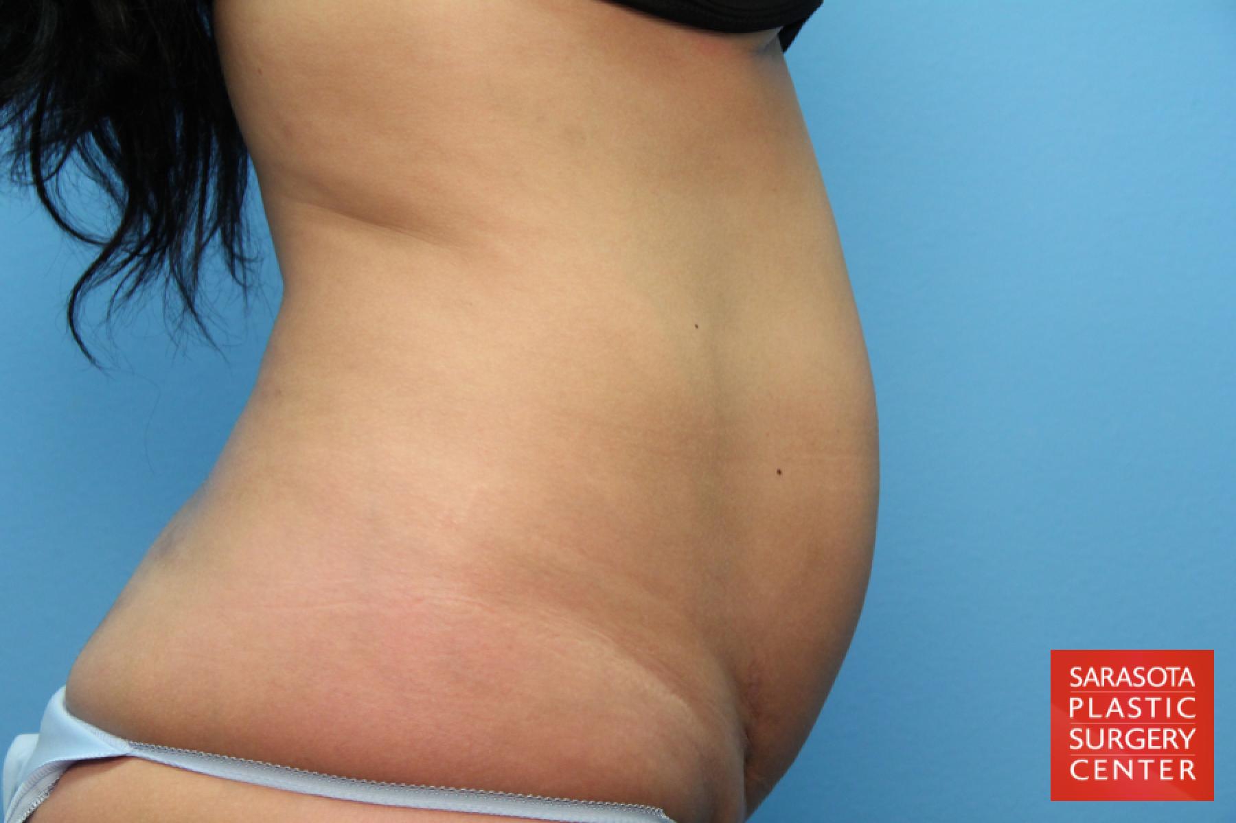 Tummy Tuck: Patient 12 - Before 7