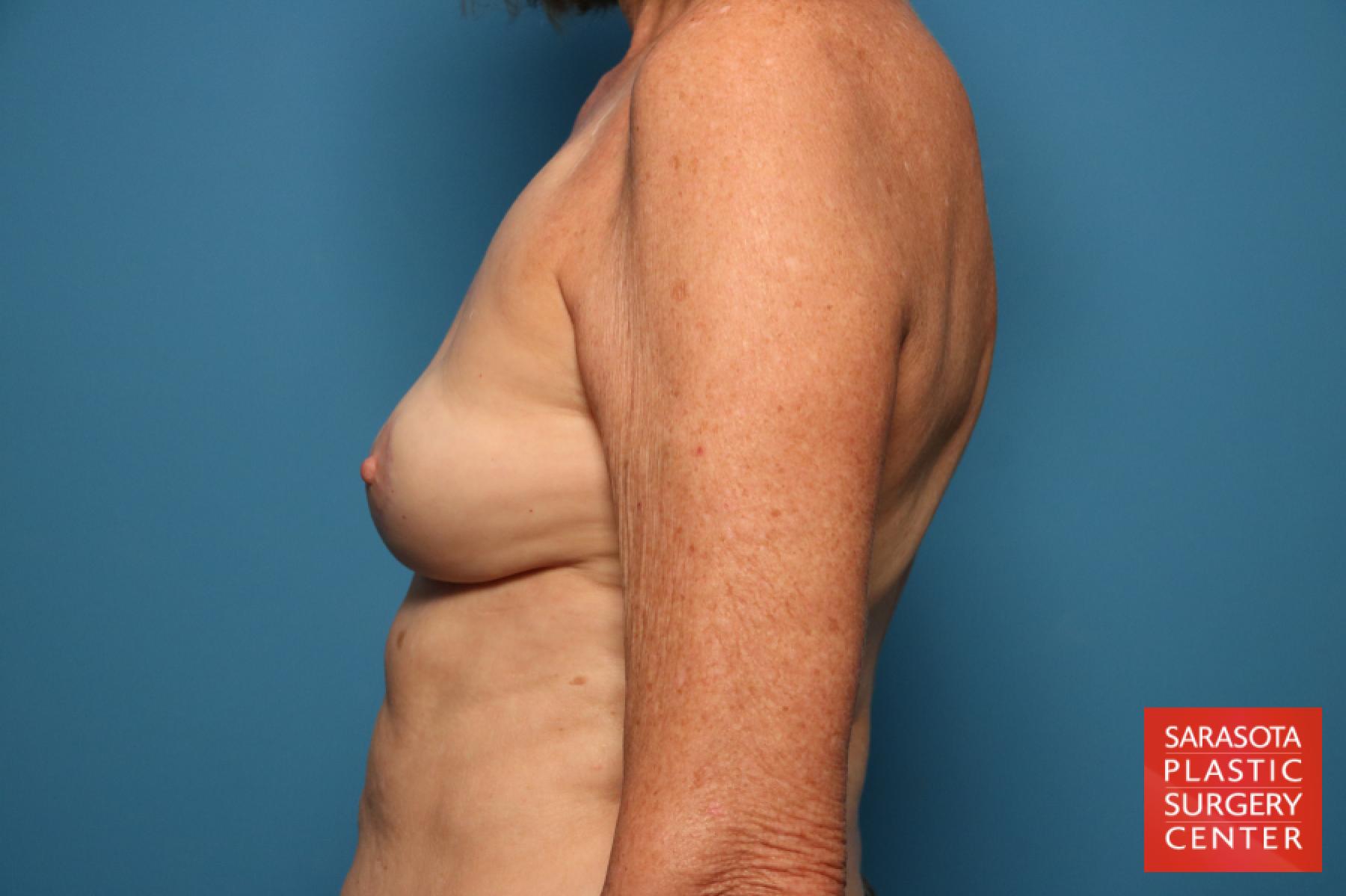 Breast Implant Removal With Lift: Patient 1 - After 3