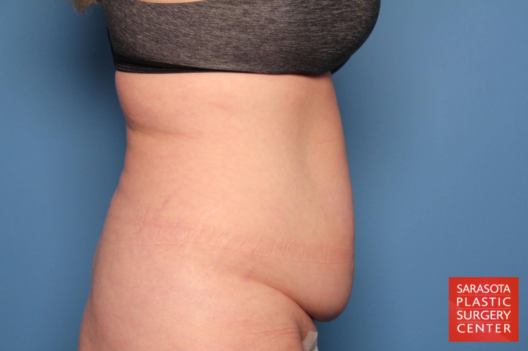 Tummy Tuck: Patient 16 - Before and After 3