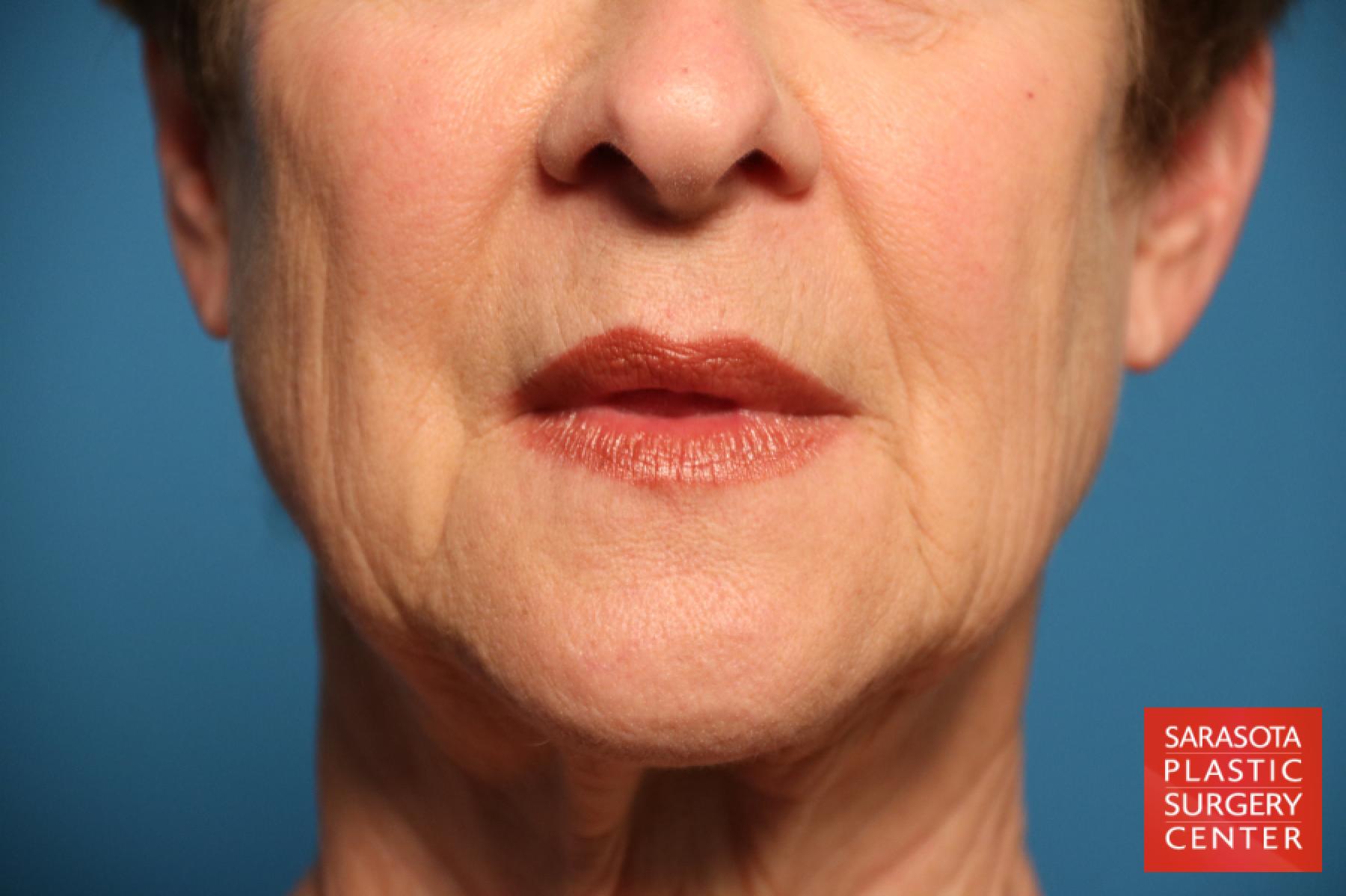 Fillers: Patient 2 - Before 
