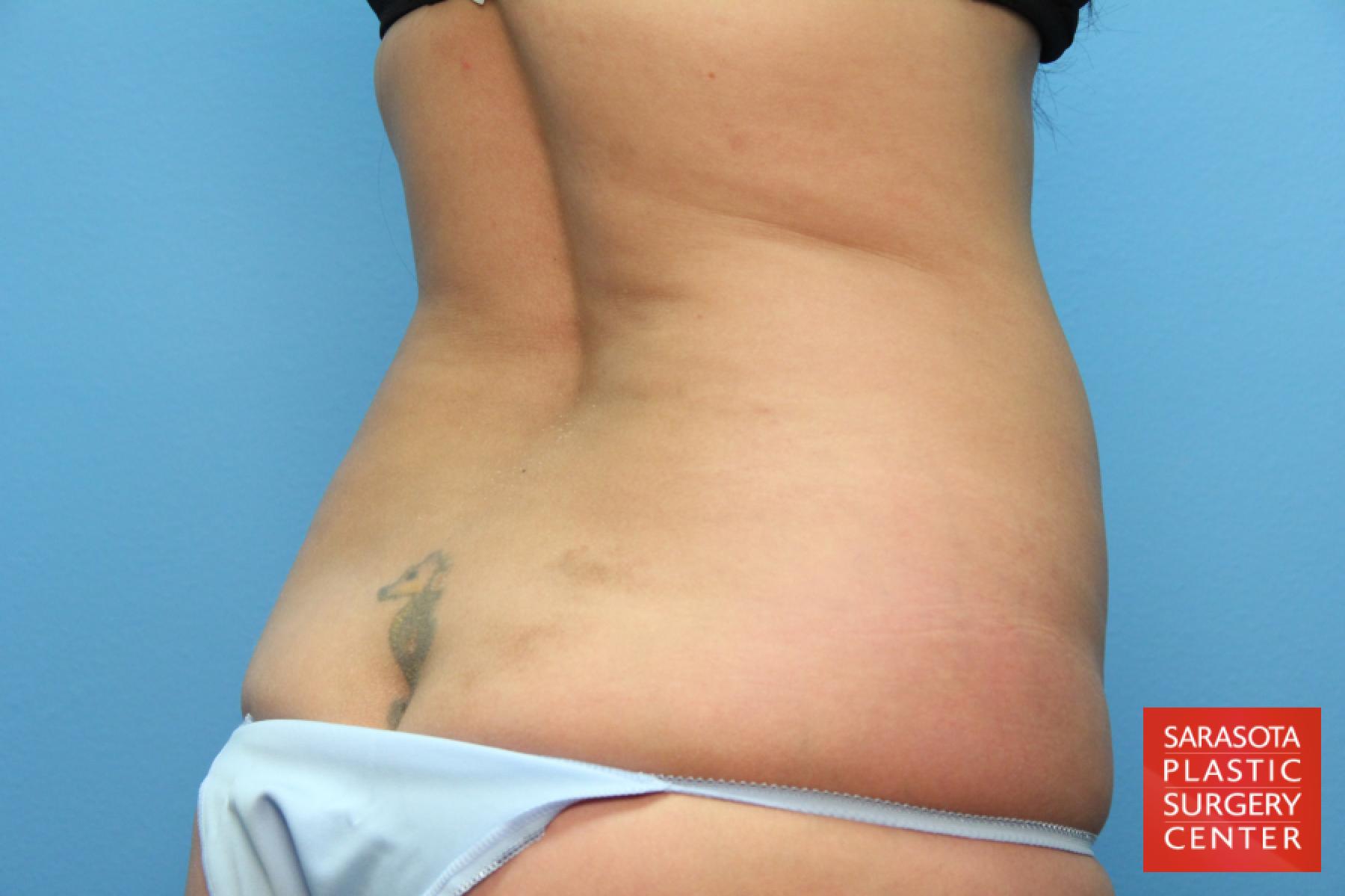 Tummy Tuck: Patient 12 - Before 6