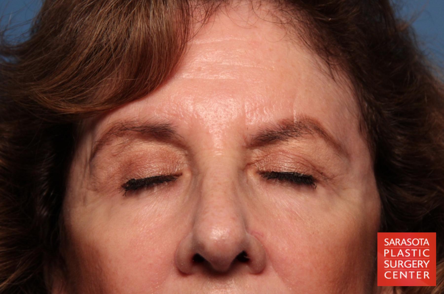Eyelid Lift: Patient 42 - After 2