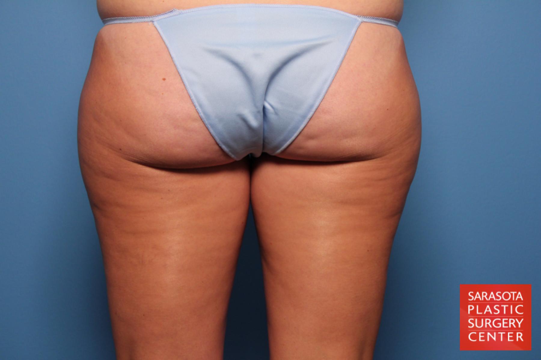 Liposuction: Patient 4 - Before 5