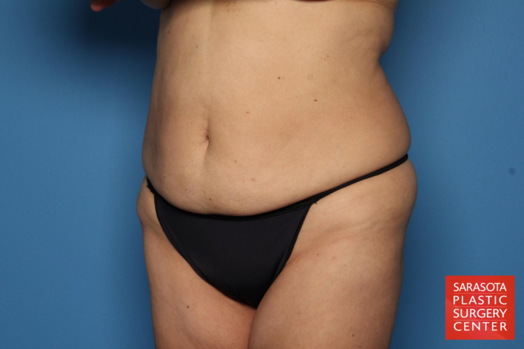 Tummy Tuck: Patient 4 - Before 2