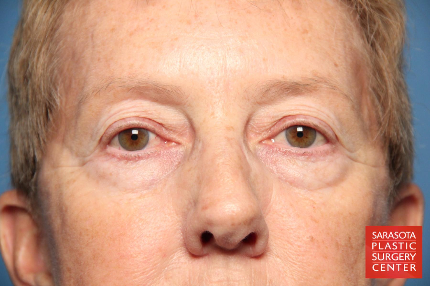 Eyelid Lift: Patient 22 - Before 1