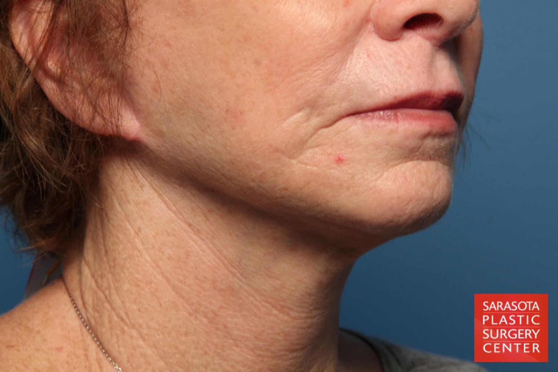 Laser Skin Resurfacing - Face: Patient 12 - After 3
