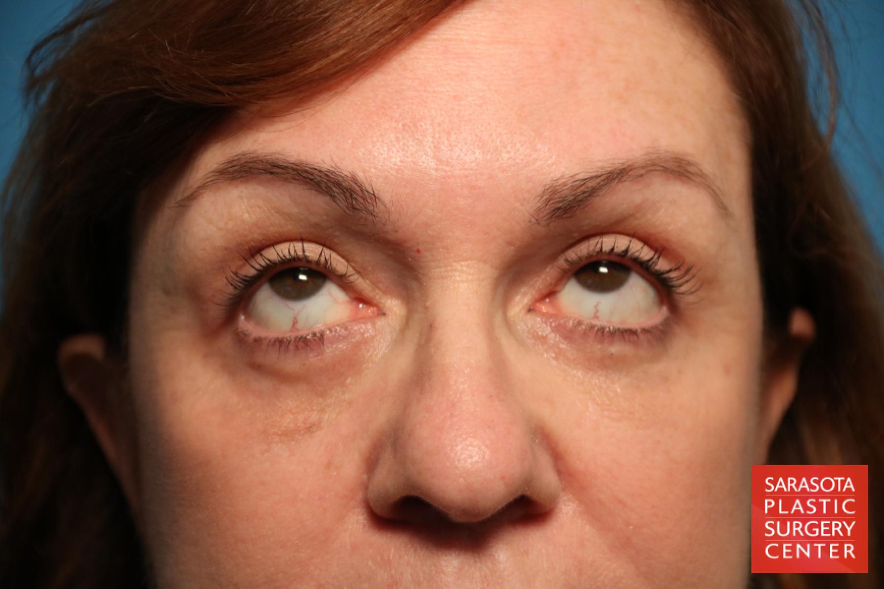 Eyelid Lift: Patient 31 - After 2
