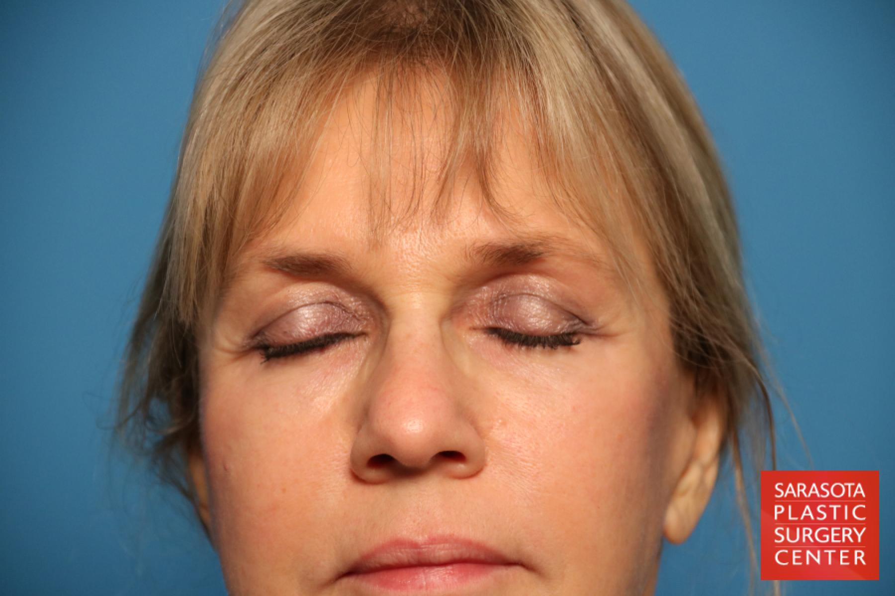 Eyelid Lift: Patient 7 - After 2