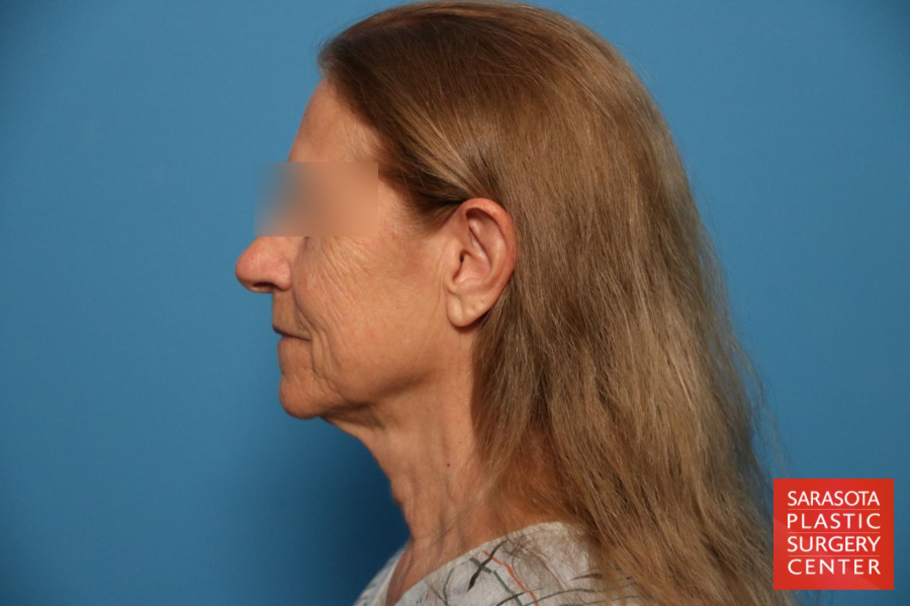 Facelift: Patient 22 - Before and After 3
